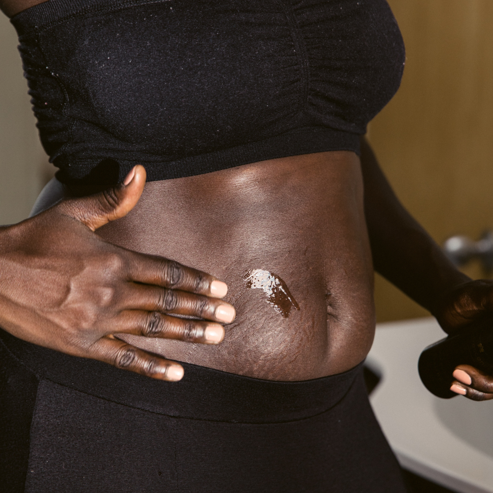 Stretch Marks & Hormonal Skin Changes—Why Your Skin Needs Extra Care